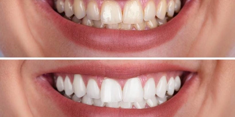 Two photos of before and after teeth whitening