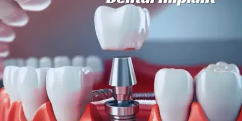 A dental implant illustration shows a tooth crown being placed onto a metal post in the gum, surrounded by natural teeth. The tone is clinical and educational.