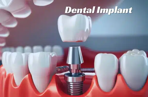 A dental implant illustration shows a tooth crown being placed onto a metal post in the gum, surrounded by natural teeth. The tone is clinical and educational.