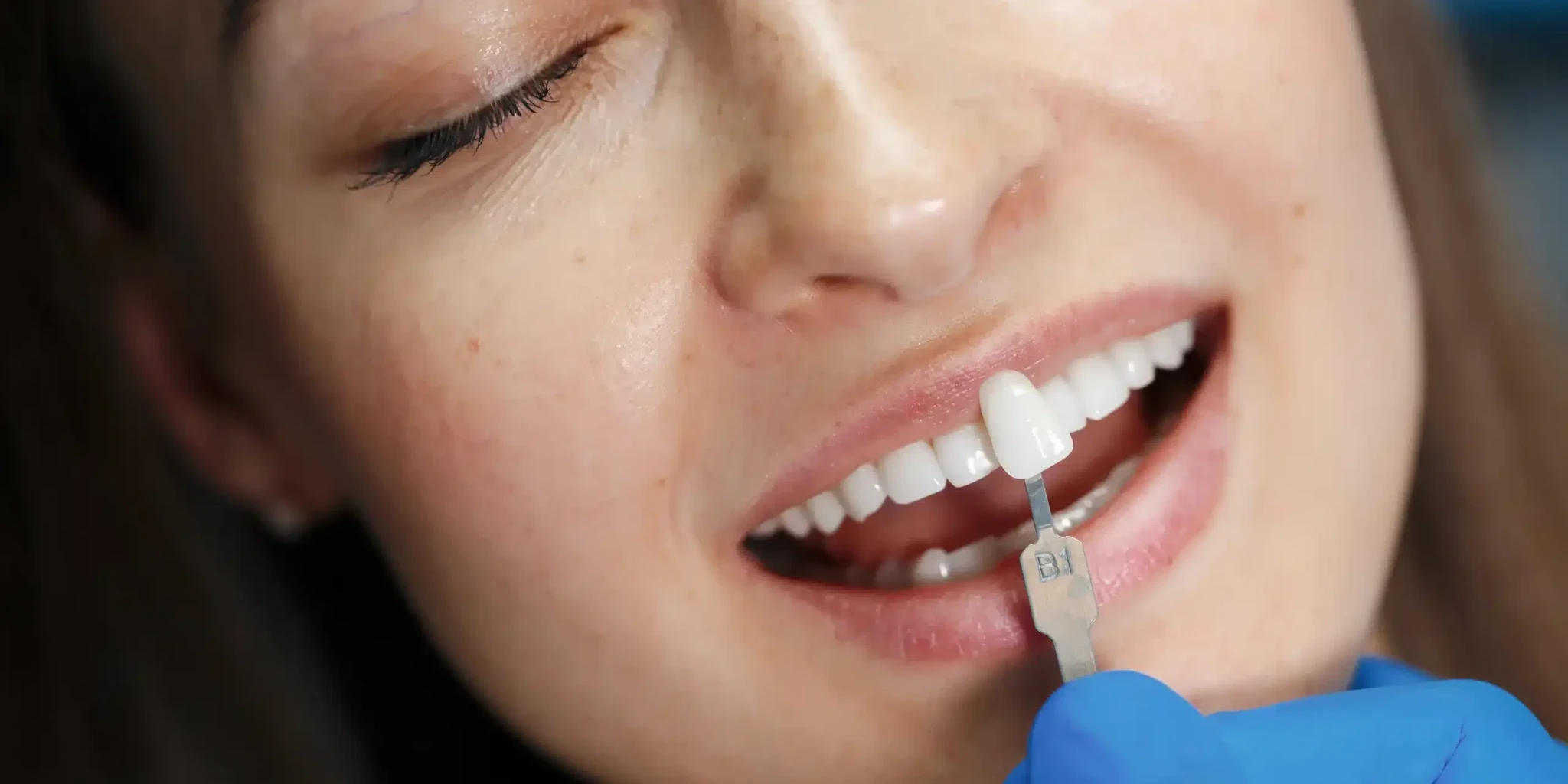 dental-veneers-for-teeth-in-cedar-knolls-nj