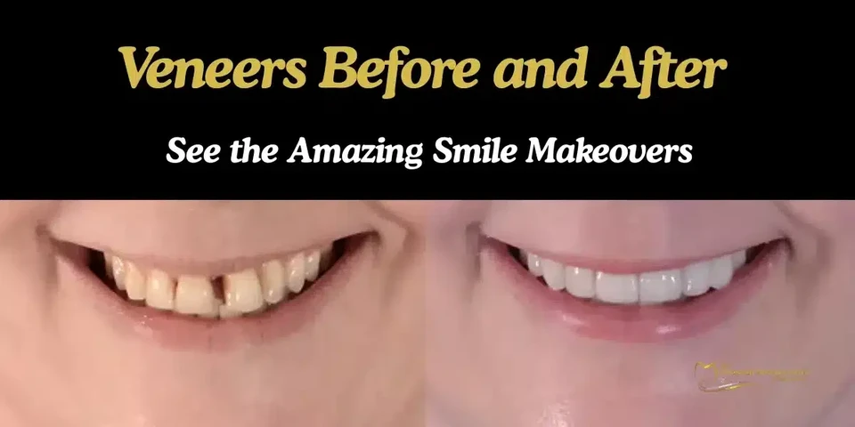 veneers-before-and-after-in-nj