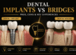 Dental Implants vs Bridges: Pros, Cons & Key Differences