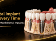 Dental Implant Recovery Time for Full-Mouth Dental Implants
