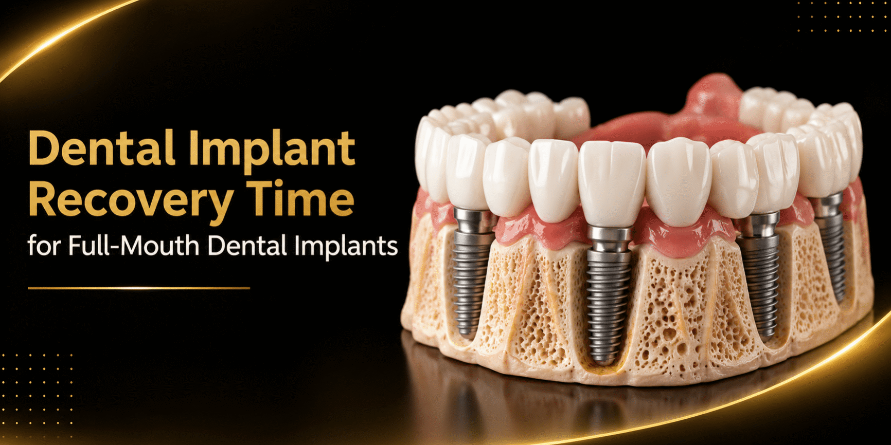 Dental Implant Recovery Time for Full-Mouth Dental Implants Dental Implant Recovery Time for Full-Mouth Dental Implants