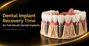 Dental Implant Recovery Time for Full-Mouth Dental Implants